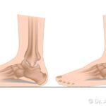 Piede Piatto dell'Adulto Immagine