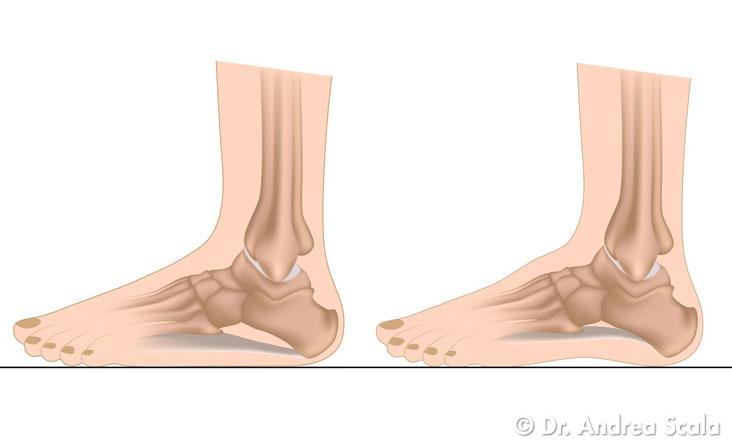Piede Piatto dell'Adulto Immagine
