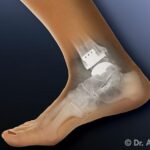 protesi di caviglia cammina