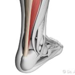 Trapianto del Tendine D'Achille