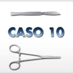 Alluce Valgo risultati Prima e Dopo