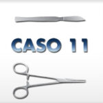 Alluce Valgo Prima e Dopo