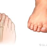 Alluce Valgo Recidivo