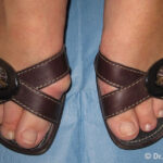 Alluce Valgo Sandali