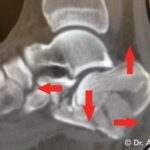 Ricostruzione Frattura Immagini