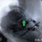 Ricostruzione Frattura del Calcagno