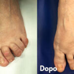 Alluce Valgo e Metatarsalgia correzione