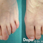 Alluce Valgo dopo 10 anni