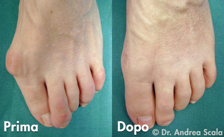 Alluce Valgo dopo 10 anni