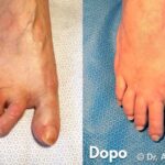 chirurgia del piede