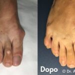 Alluce Valgo Operato 10 anni fa