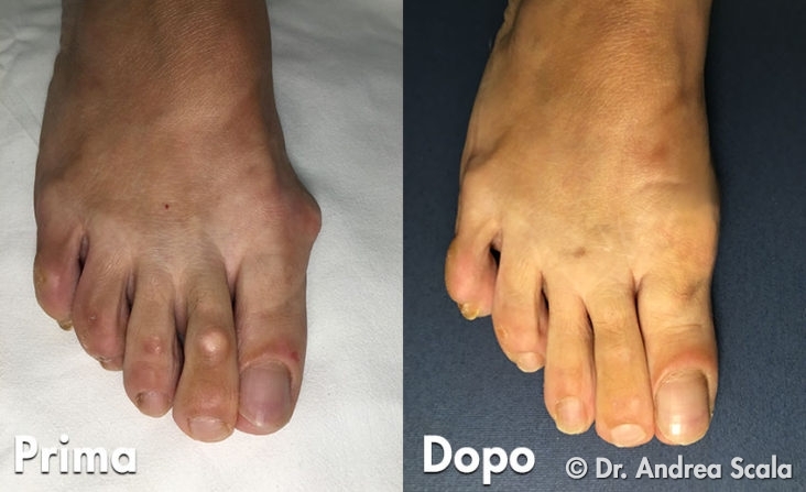 Alluce Valgo Operato 10 anni fa