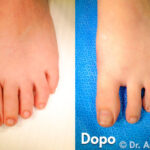Caricato inIntervento di Alluce Valgo di qualità