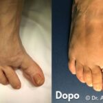 Alluce Varo caso clinico