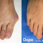 Alluce Valgo Corretto