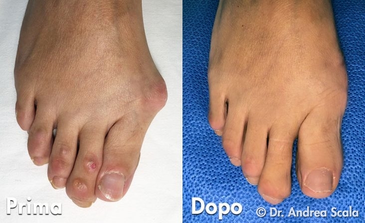 Alluce Valgo Corretto