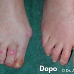 Alluce Valgo Tecnica Personalizzata