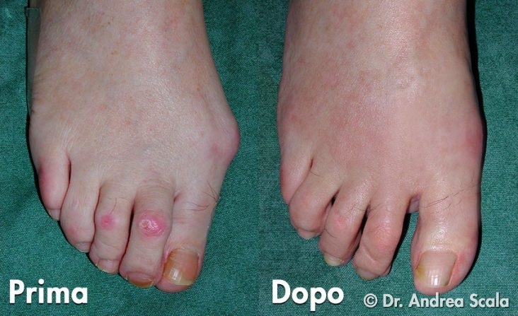 Alluce Valgo Tecnica Personalizzata