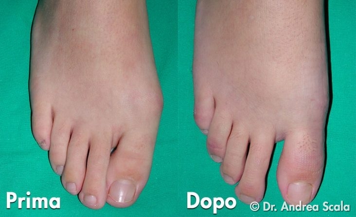 Intervento di Alluce Valgo giovanile