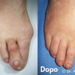 dito a martello nella correzione dell'alluce valgo