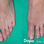 Confronto tra rimedi per Alluce Valgo