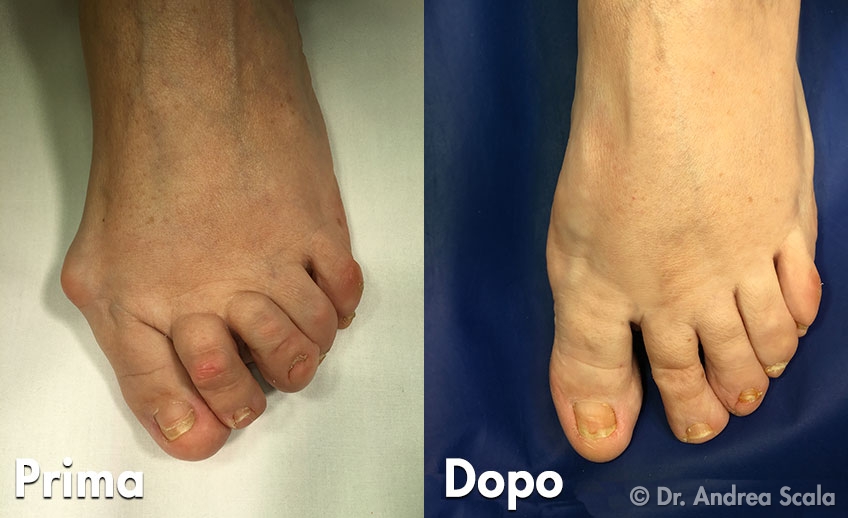 Intervento Alluce Valgo