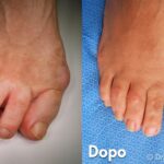 Alluce Prima e Dopo Intervento