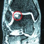 osteocondrosi astragalo