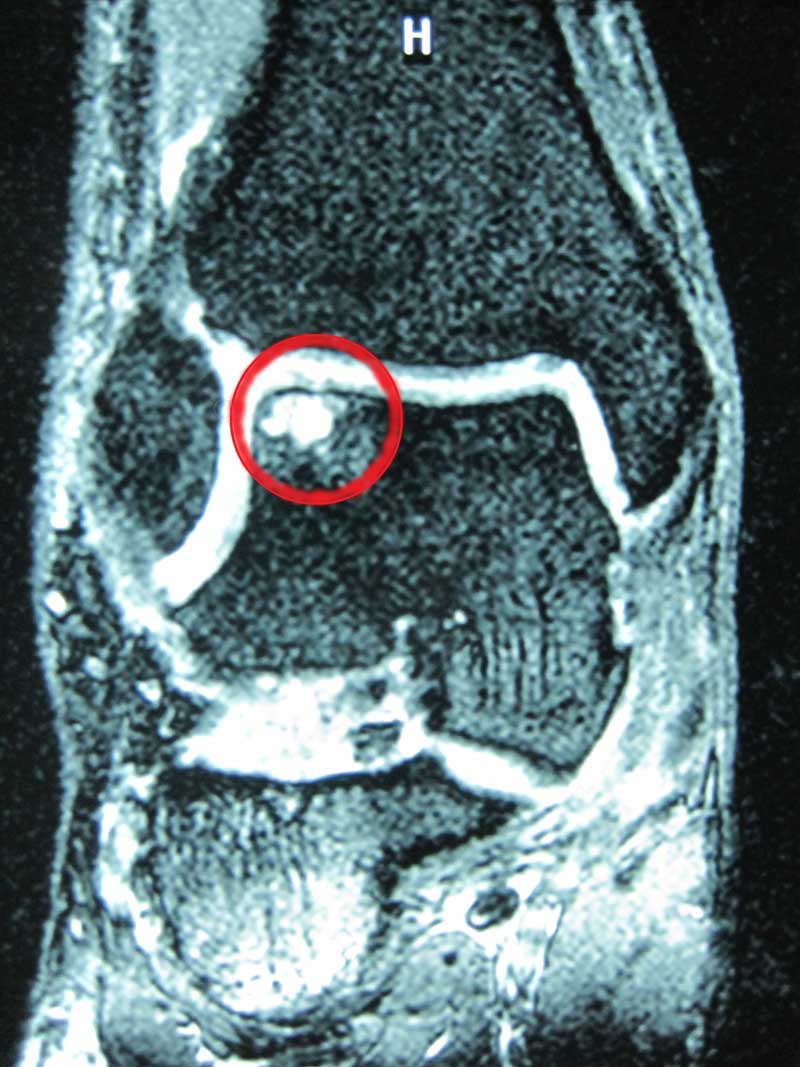 osteocondrosi astragalo