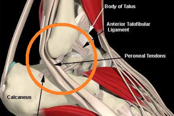 ricostruzione legamenti caviglia