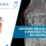 Artrosi Caviglia