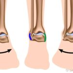 distorsione alla caviglia