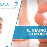 neuroma di Morton