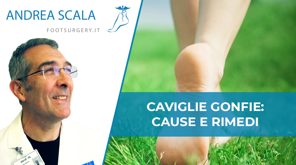 caviglie gonfie: cause
