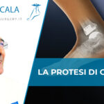 protesi di caviglia dott. Scala