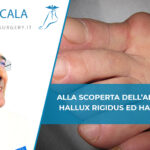 Alluce rigido copertina del Dott. Andrea Scala