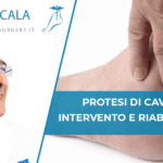 Protesi di Caviglia: intervento e riabilitazione