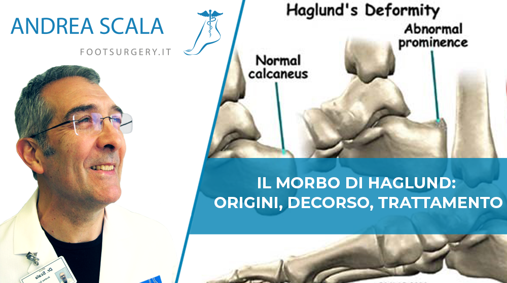 Morbo di Haglund Dottor Scala