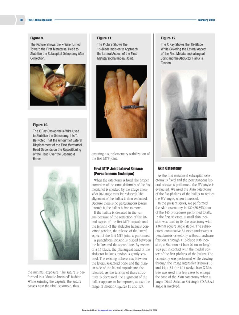 chirurgia mini-invasiva alluce valgo