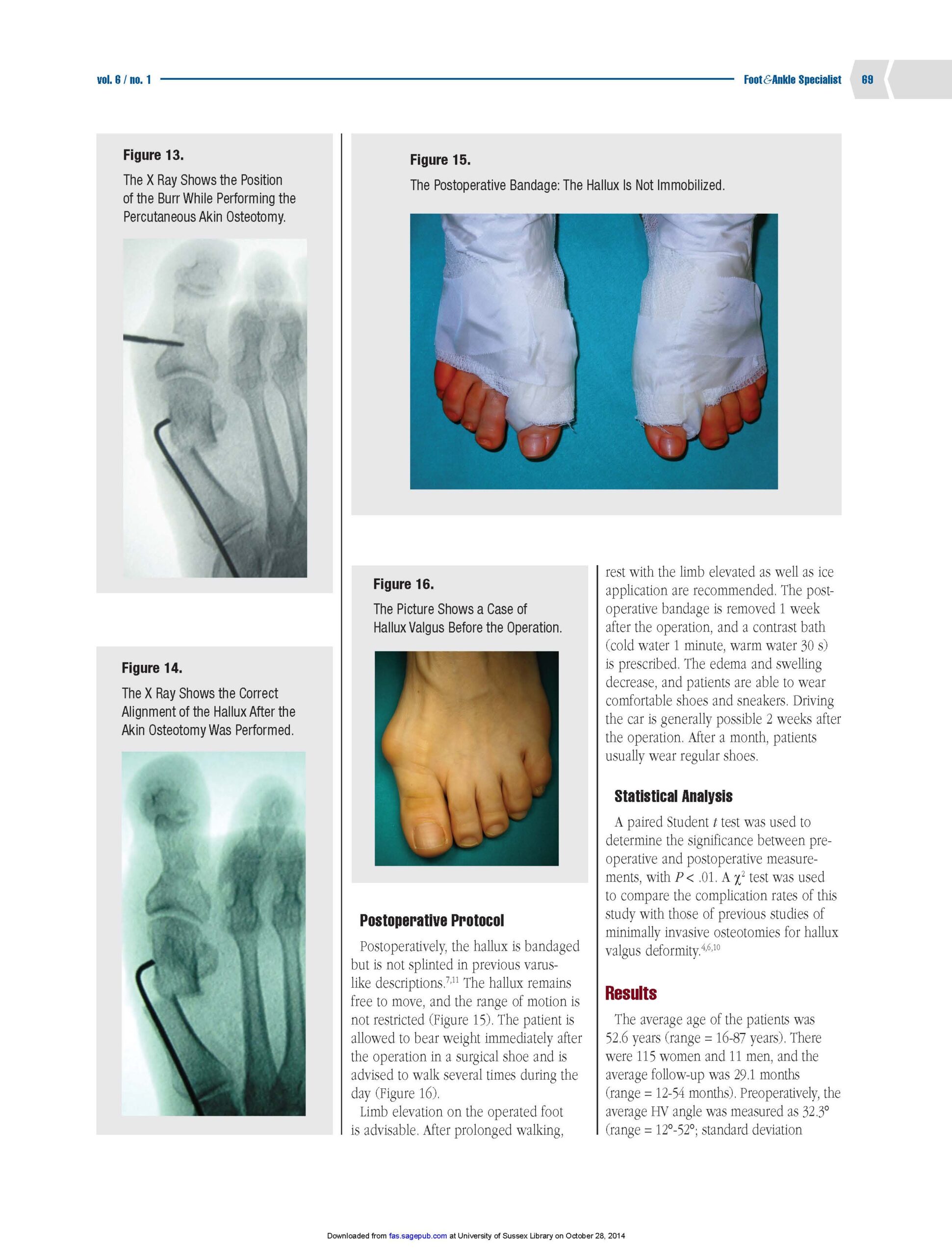 chirurgia mini-invasiva alluce valgo