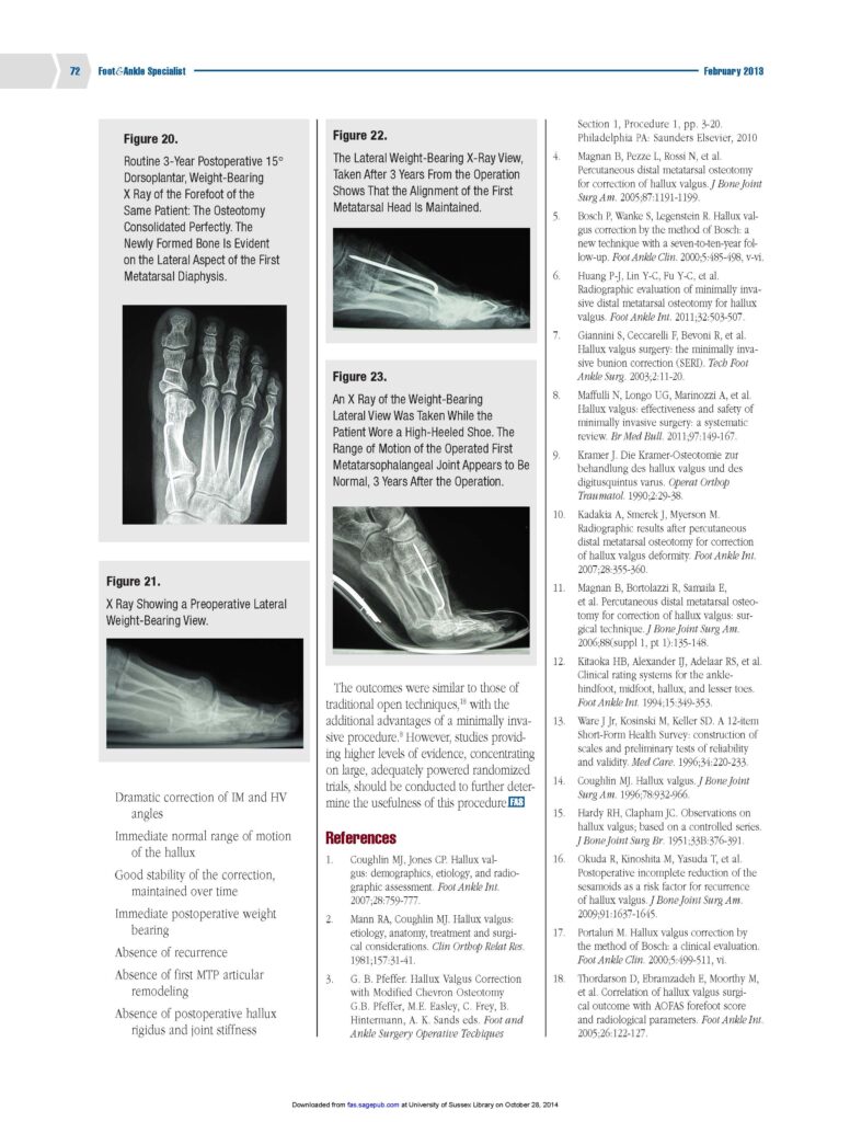 chirurgia mini-invasiva alluce valgo