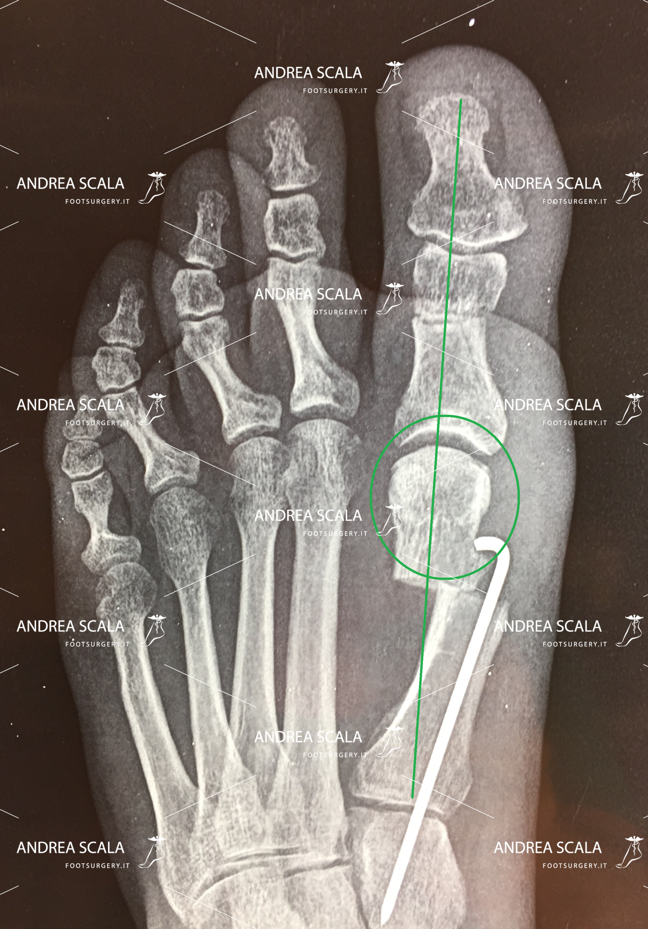 Alluce Valgo operazione