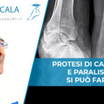 Protesi di Caviglia e paralisi dott. Scala