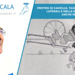 sindesmosi, no grazie. meglio la protesi di caviglia