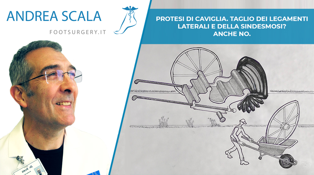 sindesmosi, no grazie. meglio la protesi di caviglia