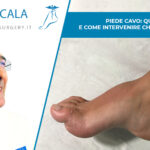 Piede Cavo: quando e come intervenire chirurgicamente