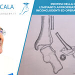PROTESI DELLA CAVIGLIA. L’impianto appropriato evita terapie inconcludenti ed operazioni non mirate.