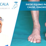 piede equino