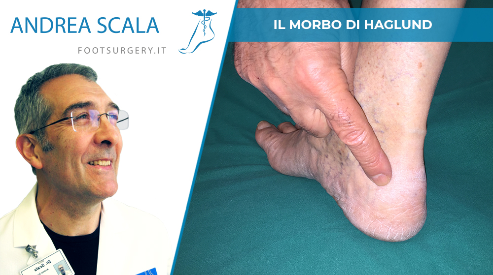 Malattia di Haglund