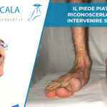 intervento piede piatto